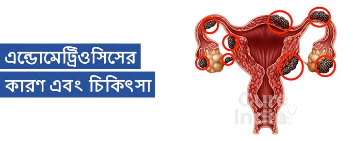 ভারতে এন্ডোমেট্রিওসিস ট্রিটমেন্ট